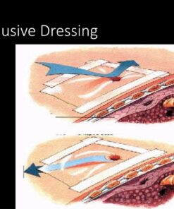 Flutter Valve (Occlusive Dressing)